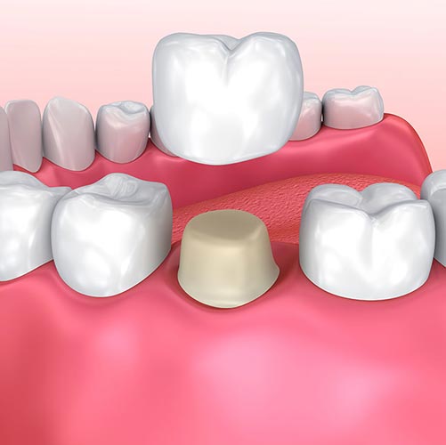 dental crowns in Brampton can be used in cosmetic and restorative dental treatments