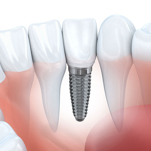 dental implant restorative dentistry in Brampton available