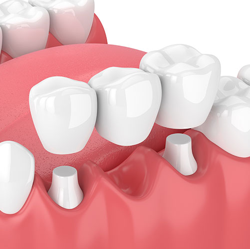 traditional dental bridges in Brampton that work best for you